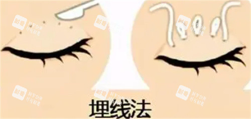 双眼皮埋线怎么做的