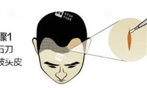 植发际线 植发际线