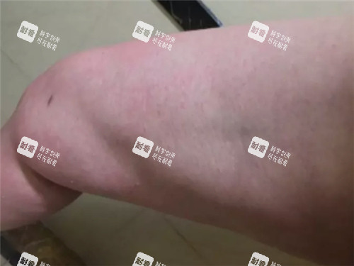 吸脂凹凸不平图示 吸脂凹凸不平图示