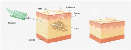 吸脂手术动画图展示 吸脂手术动画图展示