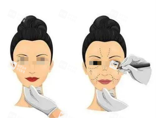 拉皮手术术前画线图