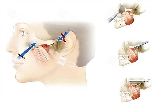 颧骨内推手术原理动画图