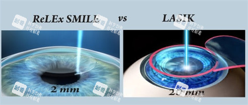 全飞秒近视手术带来的切口图解 全飞秒近视手术带来的切口图解