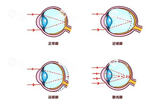 远视眼和近视眼的区别