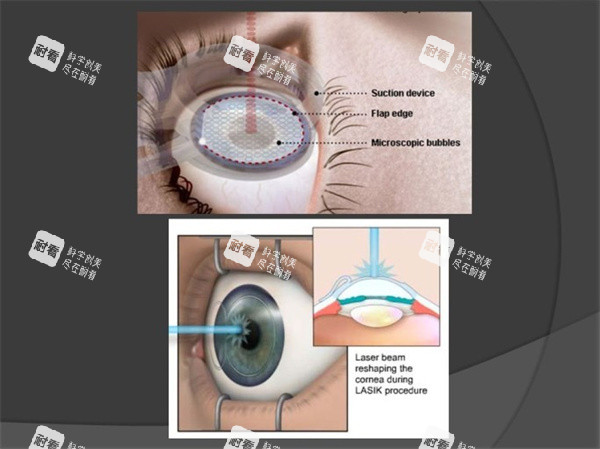 近视眼手术照片