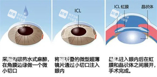 ICL手术过程