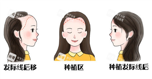 发际线后遗种植前后