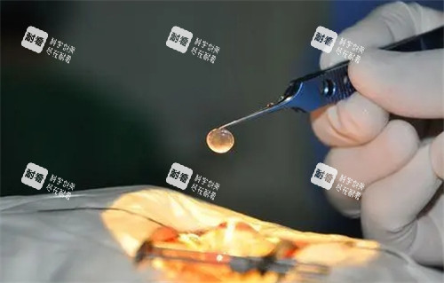 角膜移植手术细节图 角膜移植手术细节图