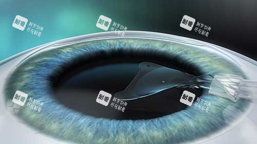 人工晶体植入演示图展示 人工晶体植入演示图展示