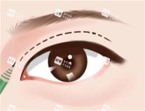 全切双眼皮手术卡通图片 全切双眼皮手术卡通图片