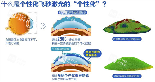 什么是个性化飞秒 什么是个性化飞秒