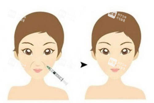 注射填充面部法令纹前后对比卡通示意图 注射填充面部法令纹前后对比卡通示意图