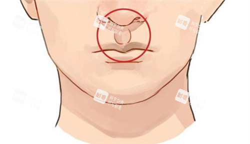 人中加深手术后 人中加深手术后