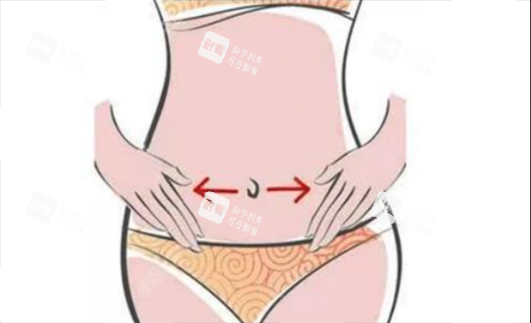 腹壁成形术2 腹壁成形术2