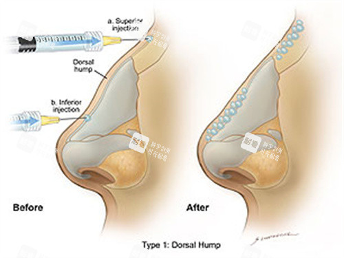 玻尿酸注射手术过程