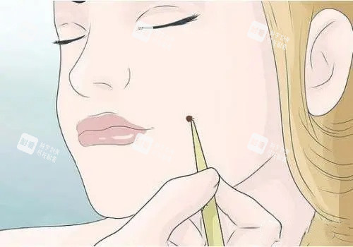 面部祛痣漫画示意图 面部祛痣漫画示意图