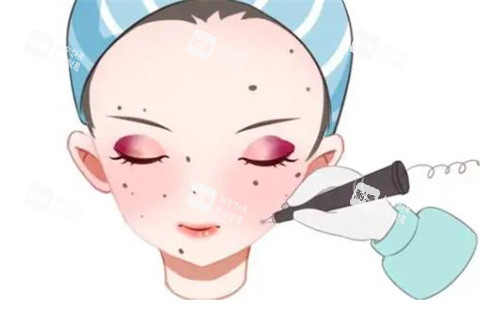 激光去痣卡通 激光去痣卡通