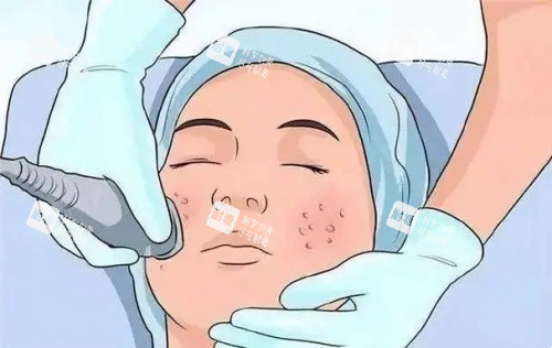 激光面部祛痣示意图 激光面部祛痣示意图