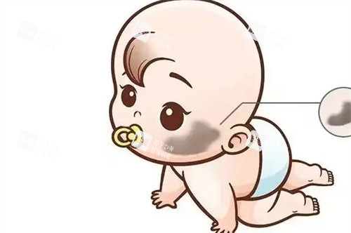 太田痣儿童 太田痣儿童