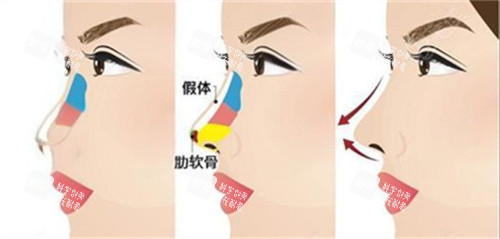 鼻综合术后对比 鼻综合术后对比