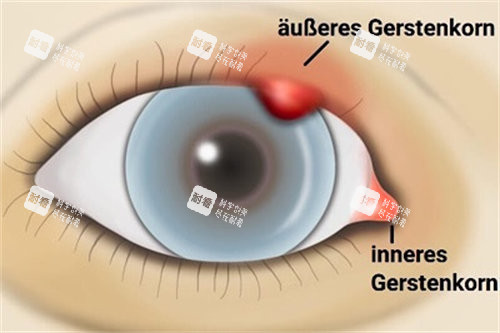 爱尔眼科麦粒肿手术多少钱？市场价格从500元起，详细费用和术后护理指南！