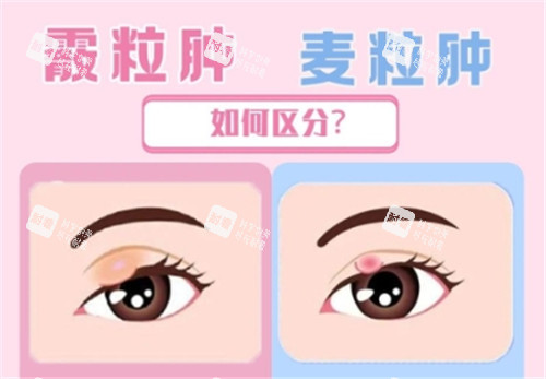霰粒肿和麦粒肿的区别 霰粒肿和麦粒肿的区别