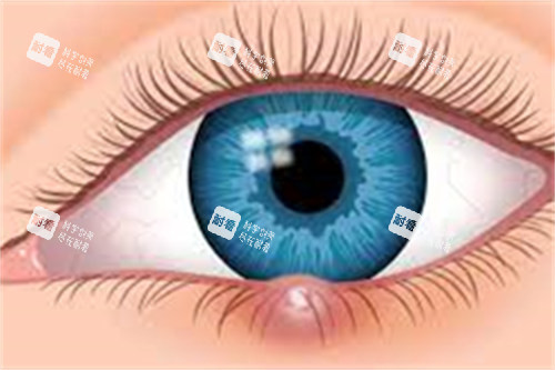 麦粒肿示意图 麦粒肿示意图