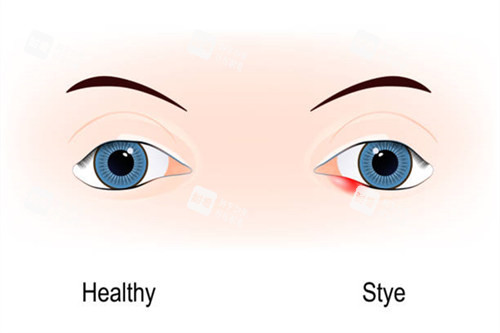 正常眼与麦粒肿眼对比图 正常眼与麦粒肿眼对比图