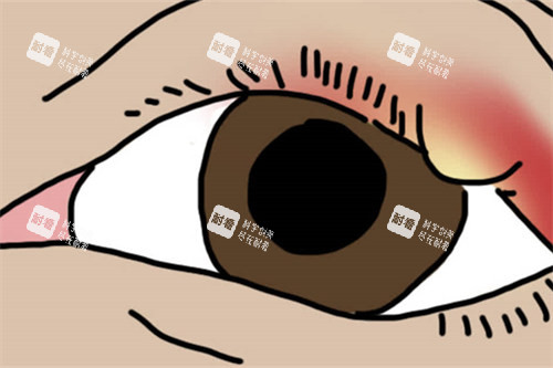 麦粒肿卡通图 麦粒肿卡通图