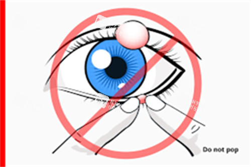 麦粒肿不可以手挤 麦粒肿不可以手挤