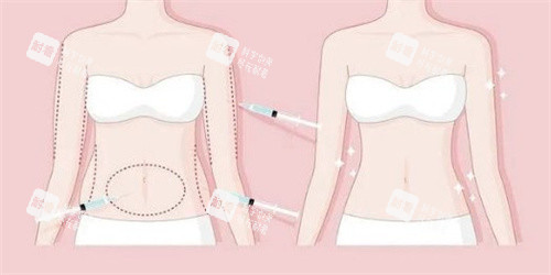 人鱼体雕术全知道：手术原理、适合人群、优缺点分析、价格参考和结果展示！