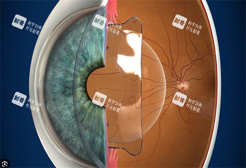 上海白内障手术能免费吗？2026年政策解读，申请条件及流程全攻略！
