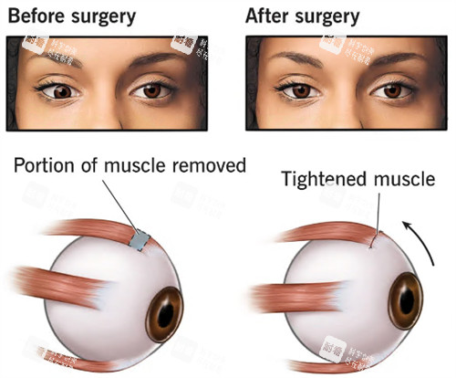 斜视手术原理展示