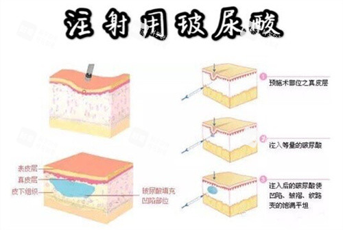 玻尿酸注射示意动画图 玻尿酸注射示意动画图
