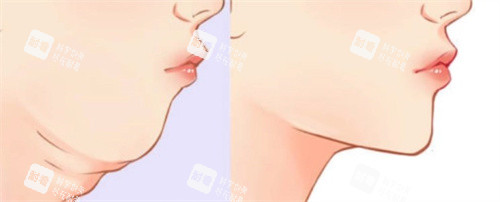 双下巴吸脂前后