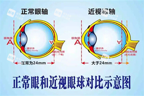 正常眼和近视眼球对比示意图 正常眼和近视眼球对比示意图