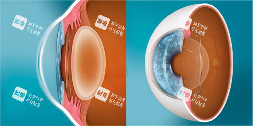 ICL晶体植入前后对比 ICL晶体植入前后对比