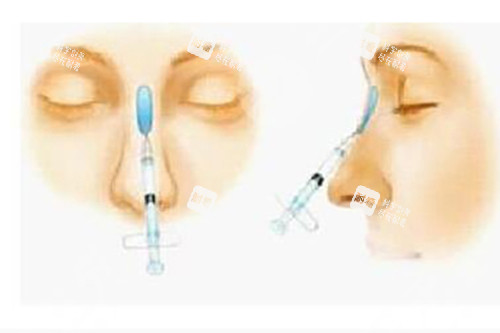 玻尿酸美容填充鼻梁示意图 玻尿酸美容填充鼻梁示意图