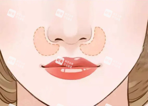 鼻基底填充 鼻基底填充