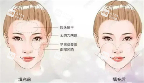 面颊填充术前后对比 面颊填充术前后对比
