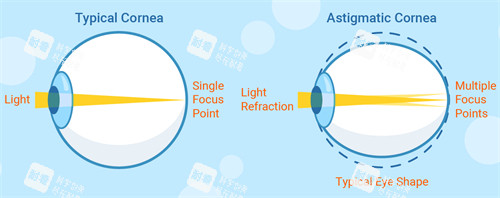 正常眼睛和散光眼睛成像不同 正常眼睛和散光眼睛成像不同