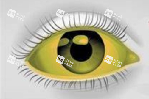 眼睛发黄示意图 眼睛发黄示意图