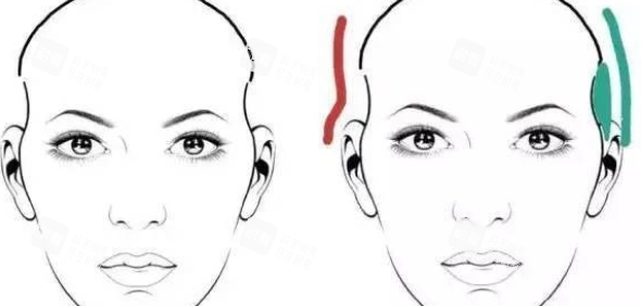 太阳穴填充前后对比 太阳穴填充前后对比