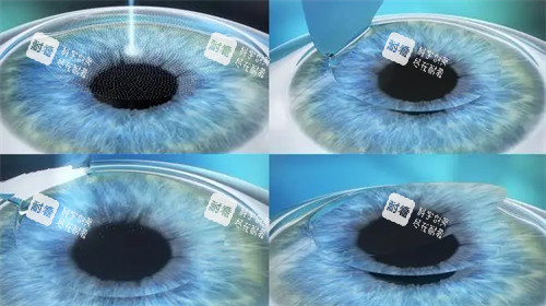 个性化微飞秒手术过程图