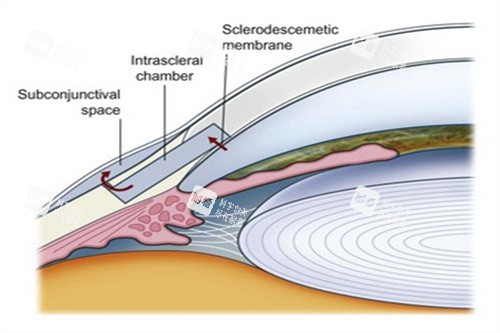 滤过行手术青光眼 滤过行手术青光眼