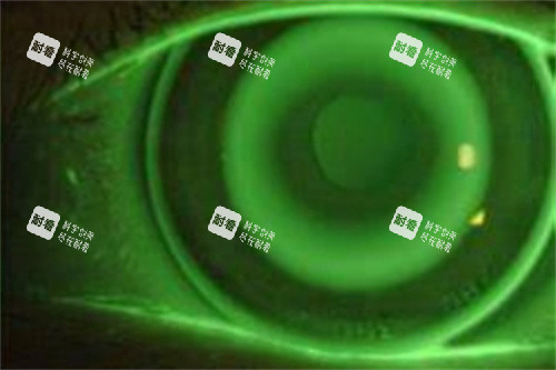 角膜塑形镜32 角膜塑形镜32