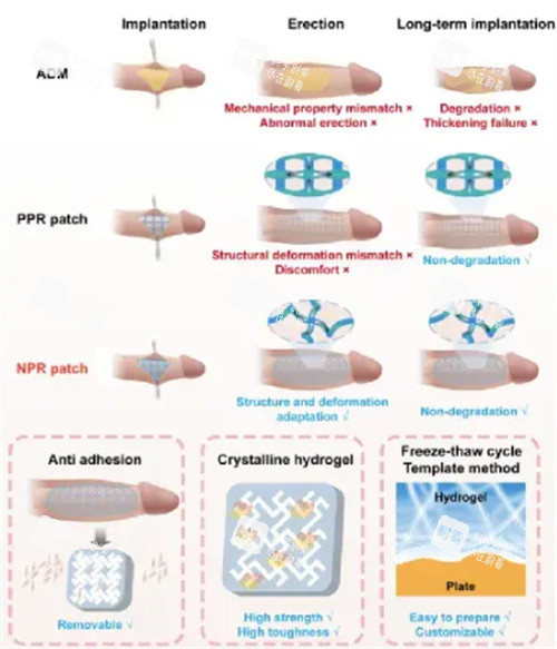 阴茎生物补片手术过程 阴茎生物补片手术过程