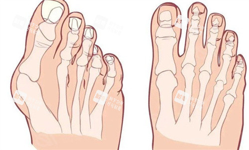 大脚骨的脚和正常对比 大脚骨的脚和正常对比