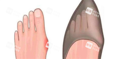 拇指外翻疼痛 拇指外翻疼痛