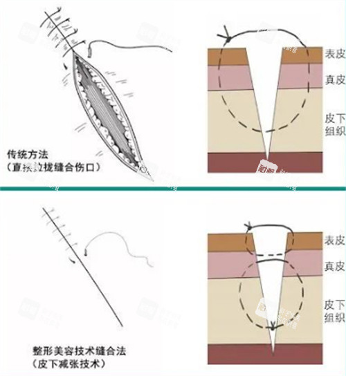 超减张精细缝合和传统缝合的区别图解 超减张精细缝合和传统缝合的区别图解